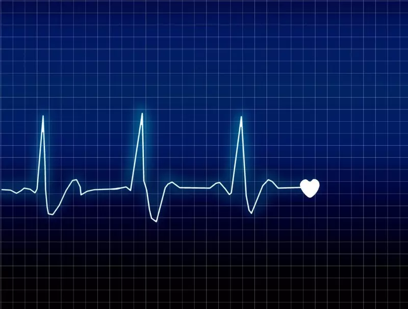 Đốt điện tim có chữa được dứt điểm bệnh rối loạn nhịp tim không?